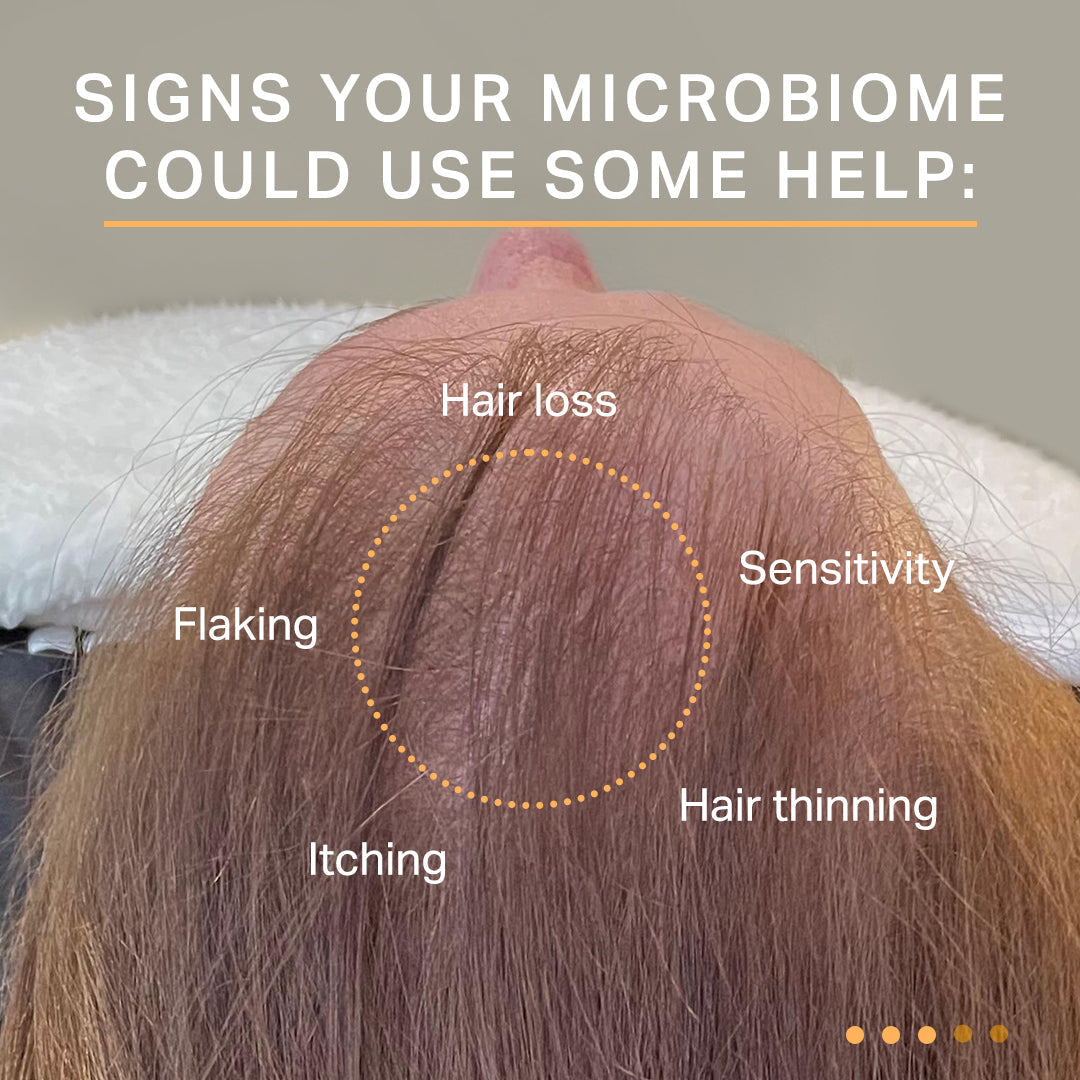 close up of a woman with hair loss. Text: signs your microbiome could use some help: hair loss, flaking, hair thinning, itiching, sensitivity