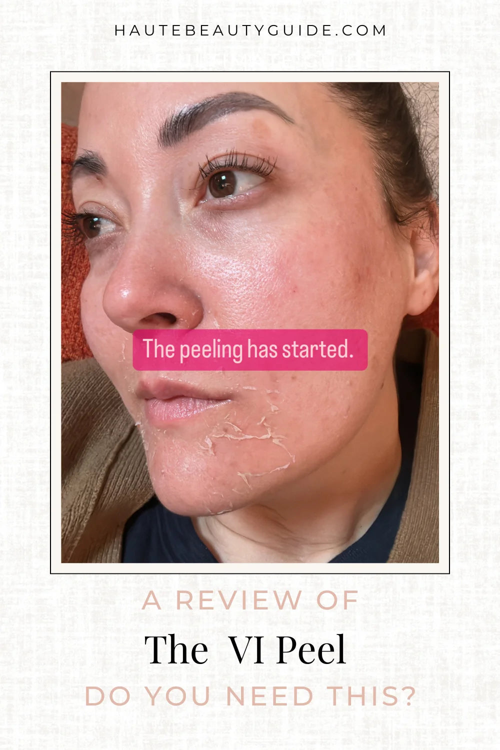 woman day 2 after a VI Peel.