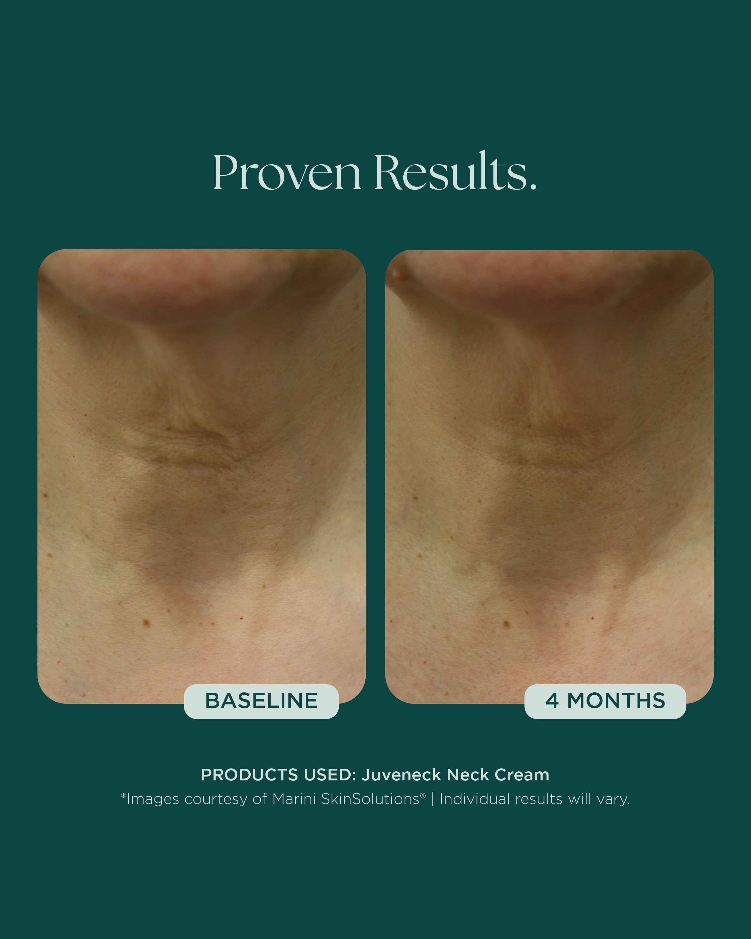 Before and after comparison of neck skin texture with Juveneck Neck Cream on a green background.