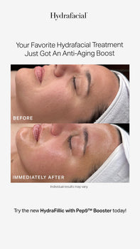 before and after of woman receiving Hydrafacial with Hydrafillic pep9 