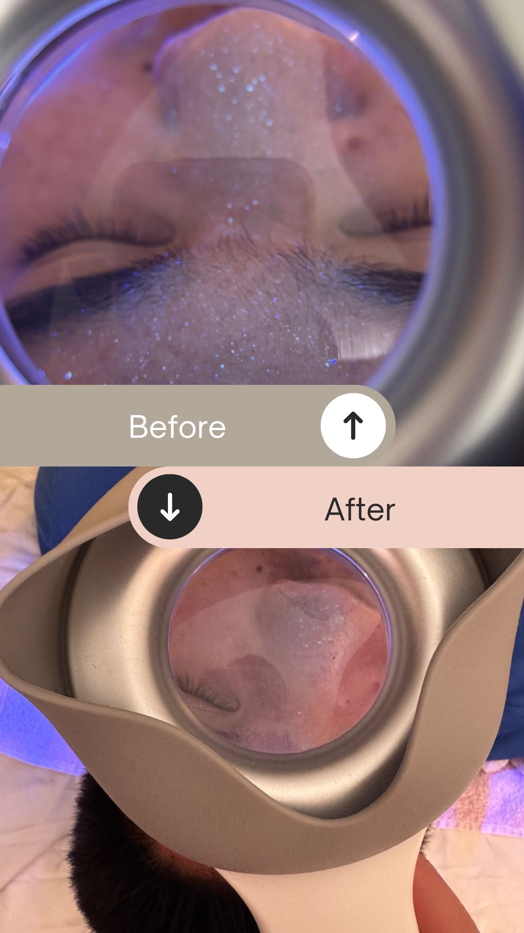 before and after of acne extractions