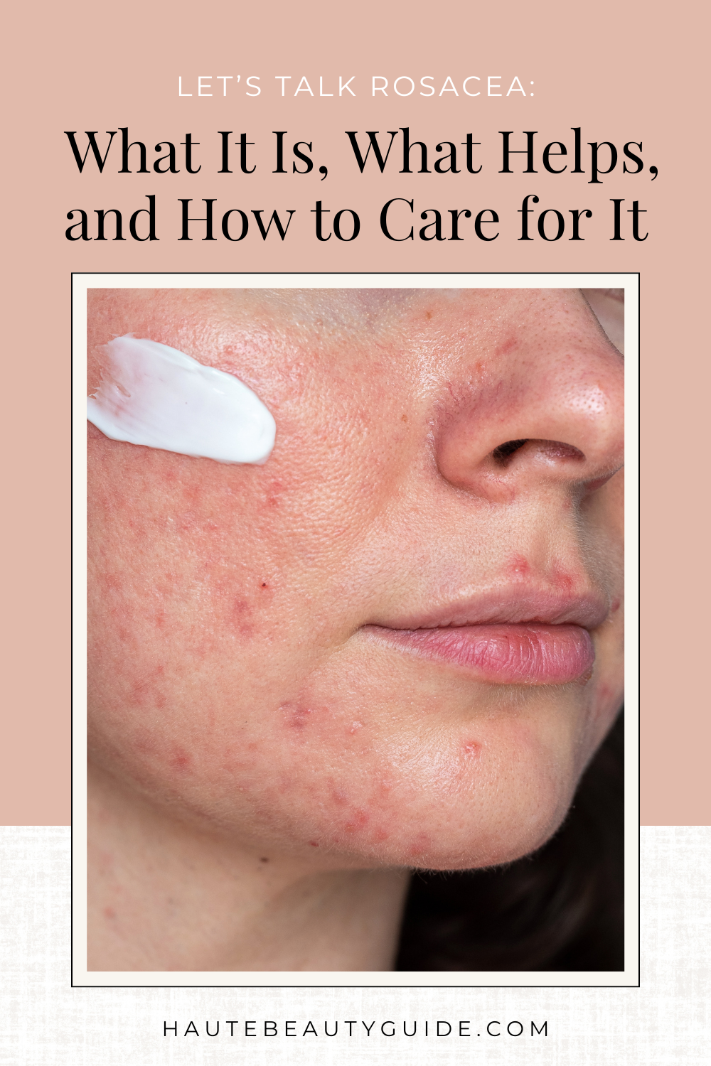 close up of woman with rosacea outbreak.
