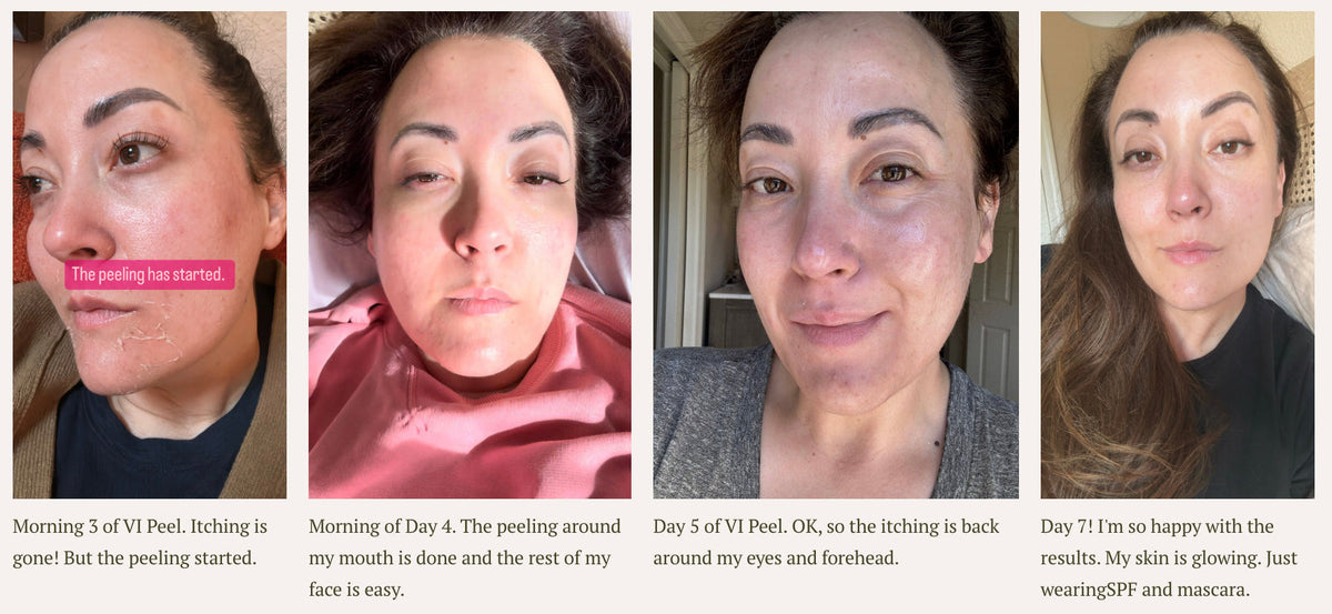 collage of before, after and during the VI Peel Process.